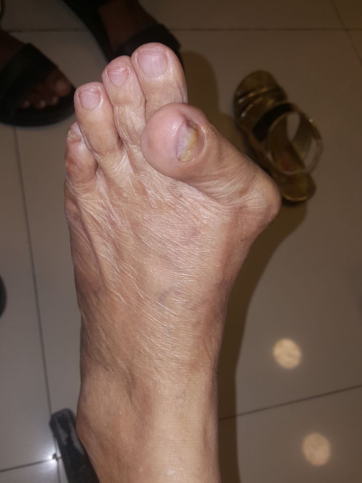 Bunion Correctors